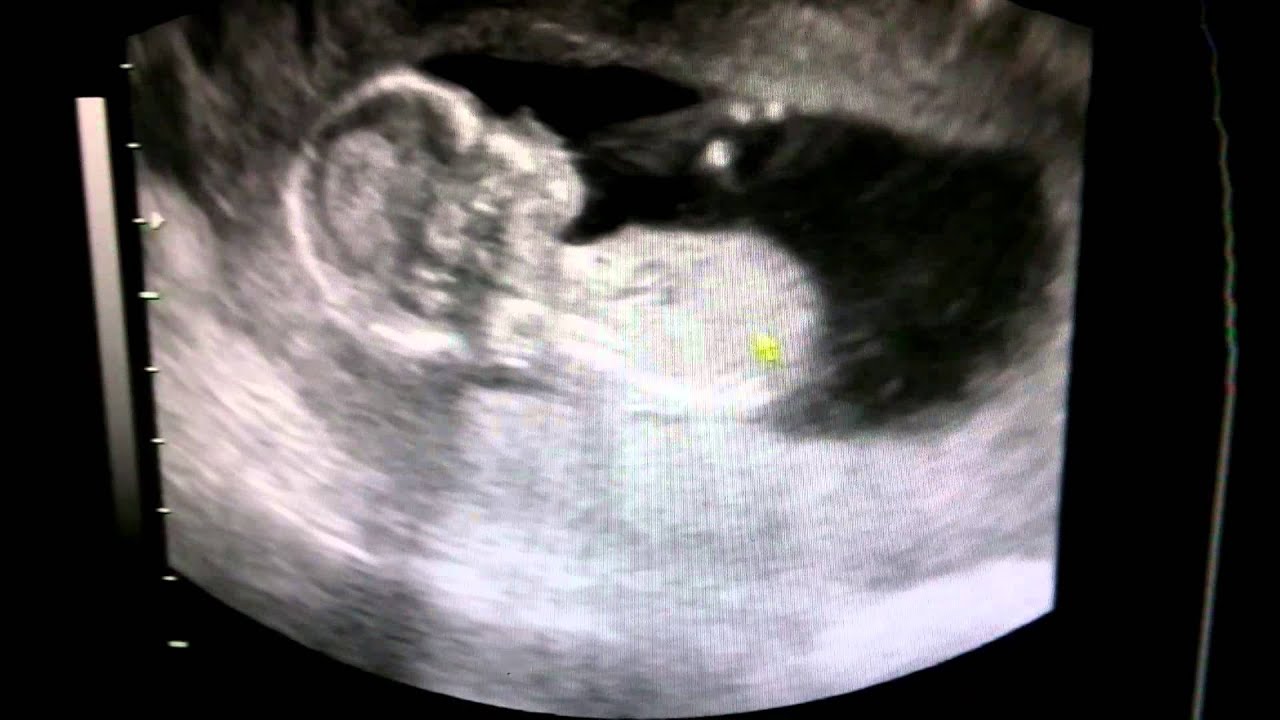 14 неделя 19. УЗИ 13-14 недель беременности мальчик. УЗИ плода на 14 неделе беременности. Ребёнок 14 недель беременности мальчик УЗИ. УЗИ 14-15 недель беременности.