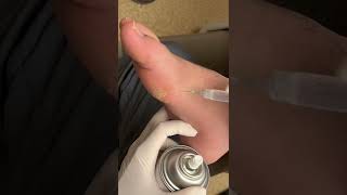 Satisfying Removal Of Plantar Wart 