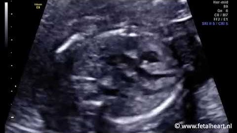 Fetal heart Academy - PA-IVS #1, LVOT