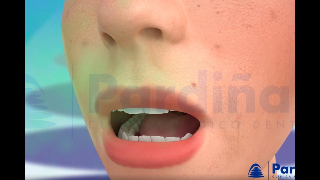 Alitosi – Alito cattivo ©