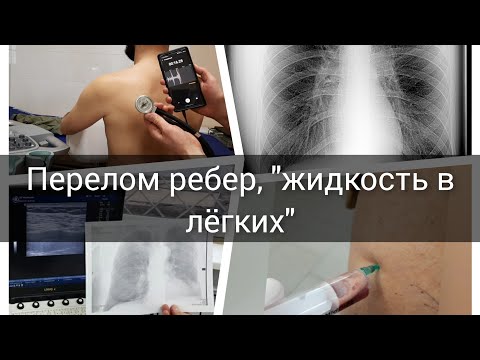 Видео: Сколько времени заживает гемоторакс?