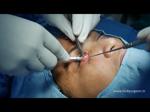 Eyelid Surgery - Eyelift - Before & After - Blepharoplasty