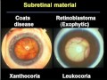 Differentiating Coats Disease from Retinoblastoma
