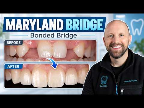 Single Wing Bonded Bridge / Maryland Bridge / Dental Implant Alternative