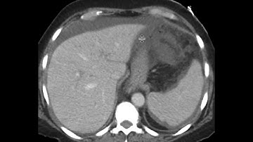Perforated gastric ulcer