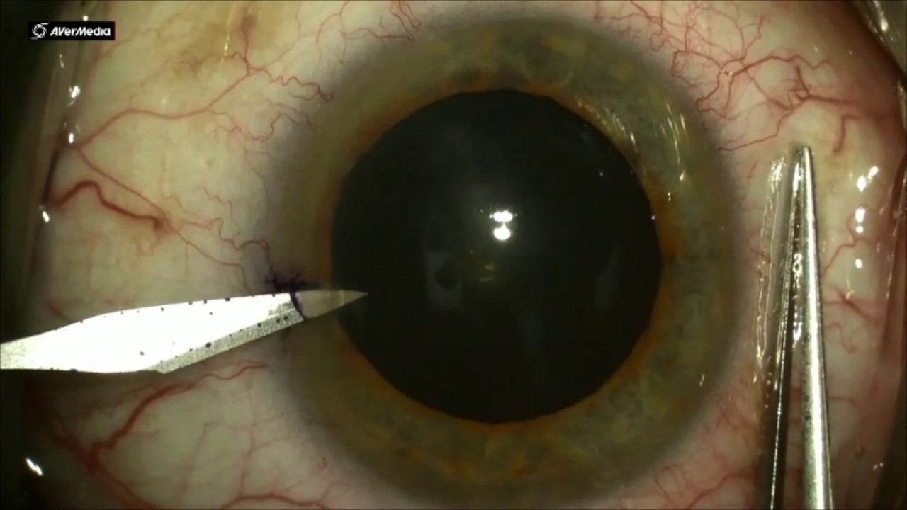 http://clinicaltrials.gov Phacoemulsification: Construction of a Side Port Wound
