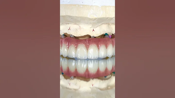 Lifelike Zirconia Implants #lsk121shorts #dentist #teeth