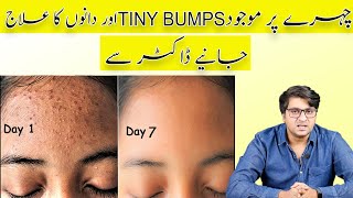 7 Days Challenge Treat TINY BUMPS on FOREHEADS | FACE NATURALLY | 100% Works Home Remedy