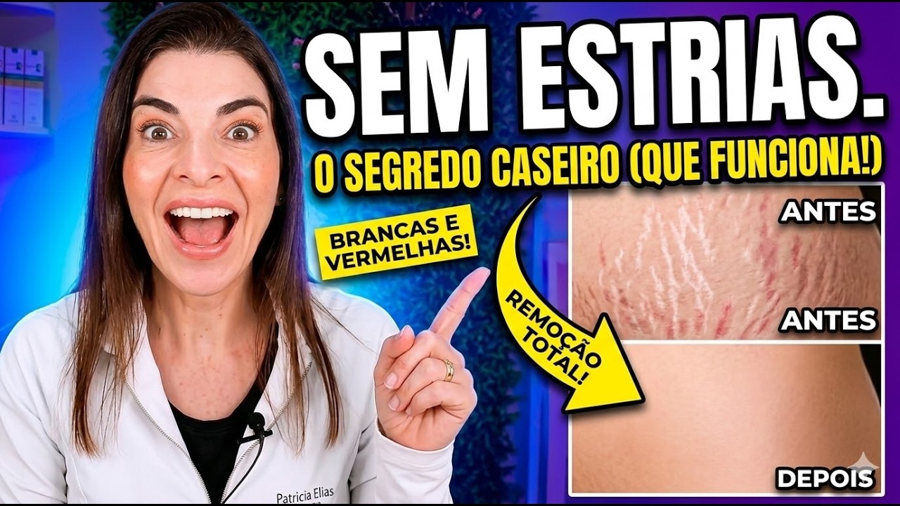ESTRIAS SUMIRAM! O Segredo Caseiro que Funciona Rápido (Brancas e Vermelhas)
