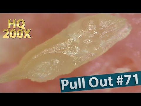 #71 Pull Out Blackheads Close up 200X - Blackheads Removal