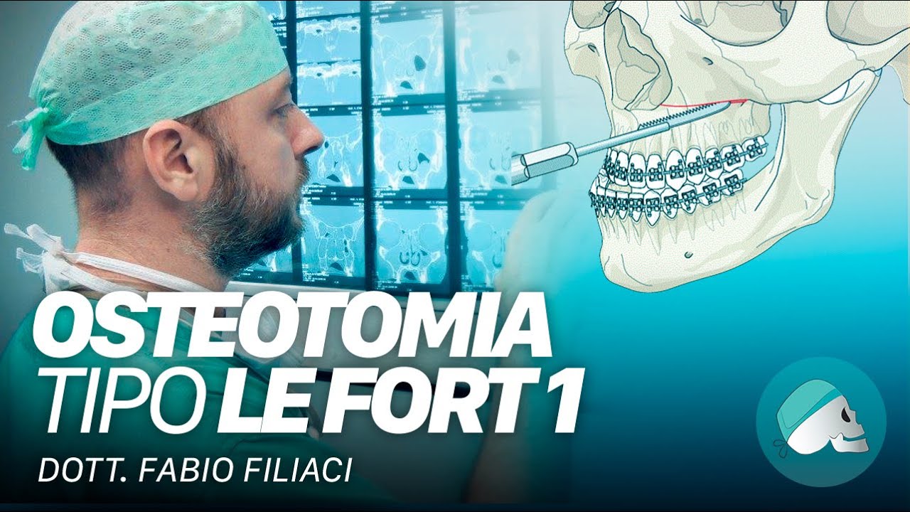 Chirurgia ortognatica - Osteotomia tipo Le Fort I