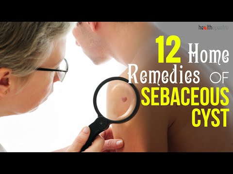 Video: Home Remedies For Cysts: What Sebenarnya Bekerja?