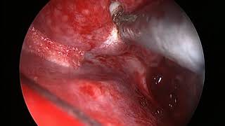 D MIDDLE MEATUS BLEEDING 1