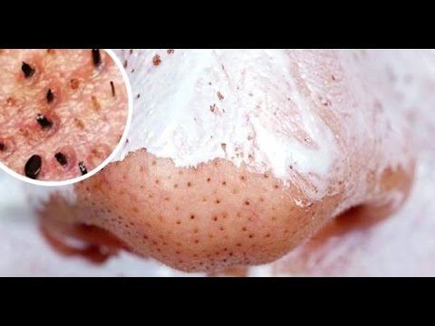 Video: Балада аллергиядан кантип арылууга болот