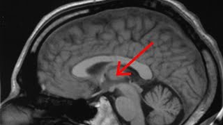 Do Lab-Grown Mini Brains Sleep? Giving Them Fatal Familial Insomnia 