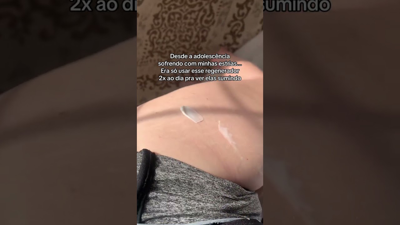 Quem também sofre com estrias da adolescência? 