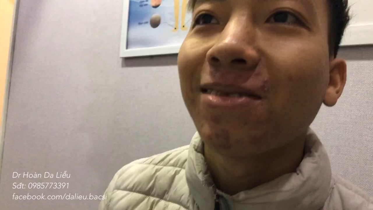 Dermatologist treating squeeze pimples, whitehead blackhead, pustule