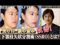 【リッツ美容外科】受け口や顔の非対称を改善するSSRO（下顎枝矢状分割術）について解説します