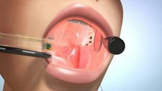 eBite with Suction Kit