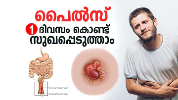 പൈൽസ് ഒരു ദിവസം കൊണ്ട് സുഖപ്പെടുത്താം | Piles Malayalam Health Tips