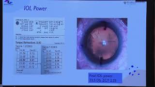 AIOC 2026 - IC45 -Dr.Ikeda Prior Radial Keratotomy - Getting Biometry Right in the Most Challengi..