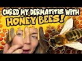 How HONEY BEES Cured my Dermatitis! (Part 3)