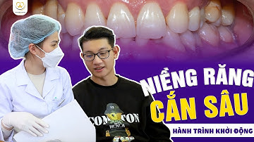 Niềng Răng Cắn Sâu – Hành Trình Tái Tạo Khớp Cắn Chuẩn Xác | Bác Sĩ Trung Long Biên