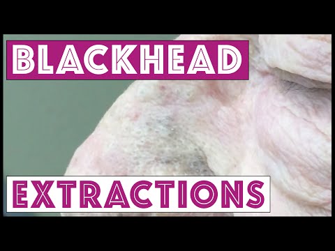 Pops! More Blackheads, TNTC. It's His First Session So Be Patient! For Medical Education- NSFE.