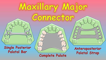 Maxillary Major Connectors | Removable Partial Denture (RPD) | Prosthodontics