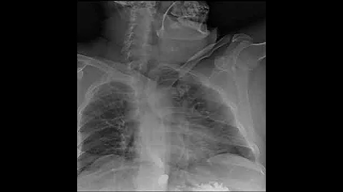 Dynamic Digital Radiology Retrospective View of Esophagus: Esophagogastroduodenoscopy (SEGD) part 3