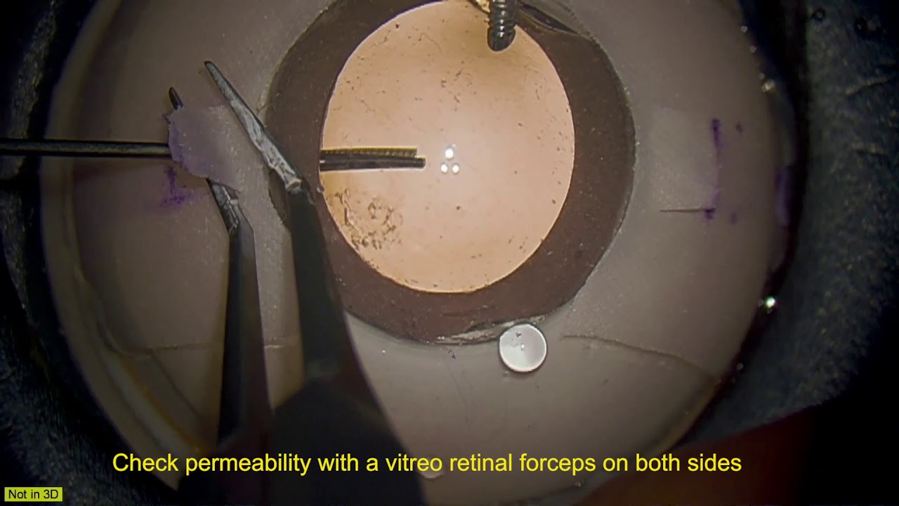 Learning intrascleral IOL fixation with artificial eyes YouTube