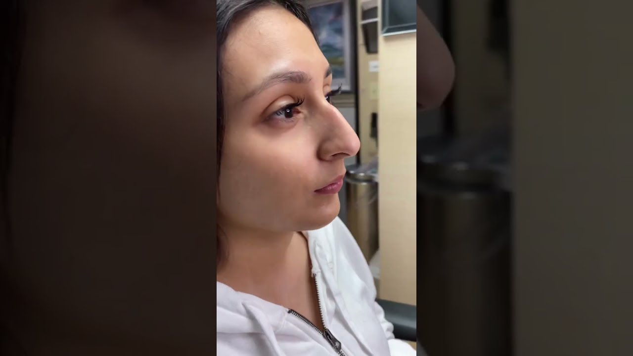Scarless Nose Rhinoplasty 1 Year Postop 7 Day Rapid Recovery And Can Fly Back To Your Home 