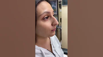 Scarless Nose Rhinoplasty 1 Year Postop 7 Day Rapid Recovery And Can Fly Back To Your Home 
