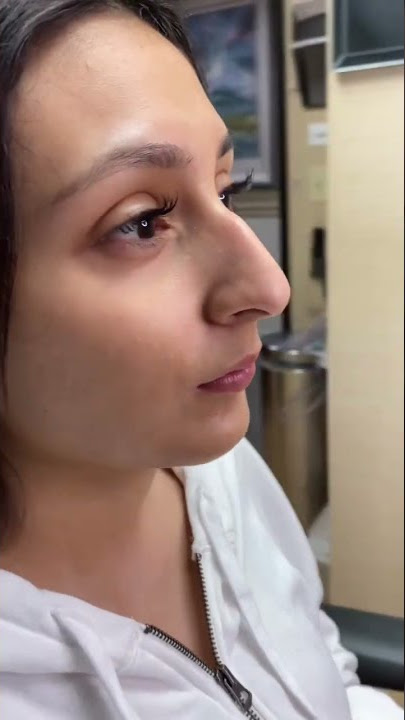 Scarless Nose™️ Rhinoplasty 1 year postop! 7 day rapid recovery and can fly back to your home!