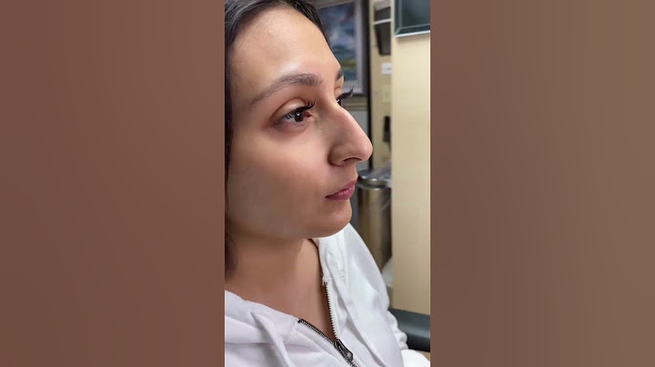 Scarless Nose™️ Rhinoplasty 1 year postop! 7 day rapid recovery and can fly back to your home!
