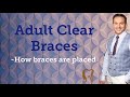 Adult Clear Braces | Miami Dentist Demonstrates Placement of Braces