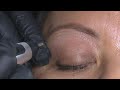 Web Exclusive: How the Plasma Pen Works to Combat Fine Lines and Wrinkles