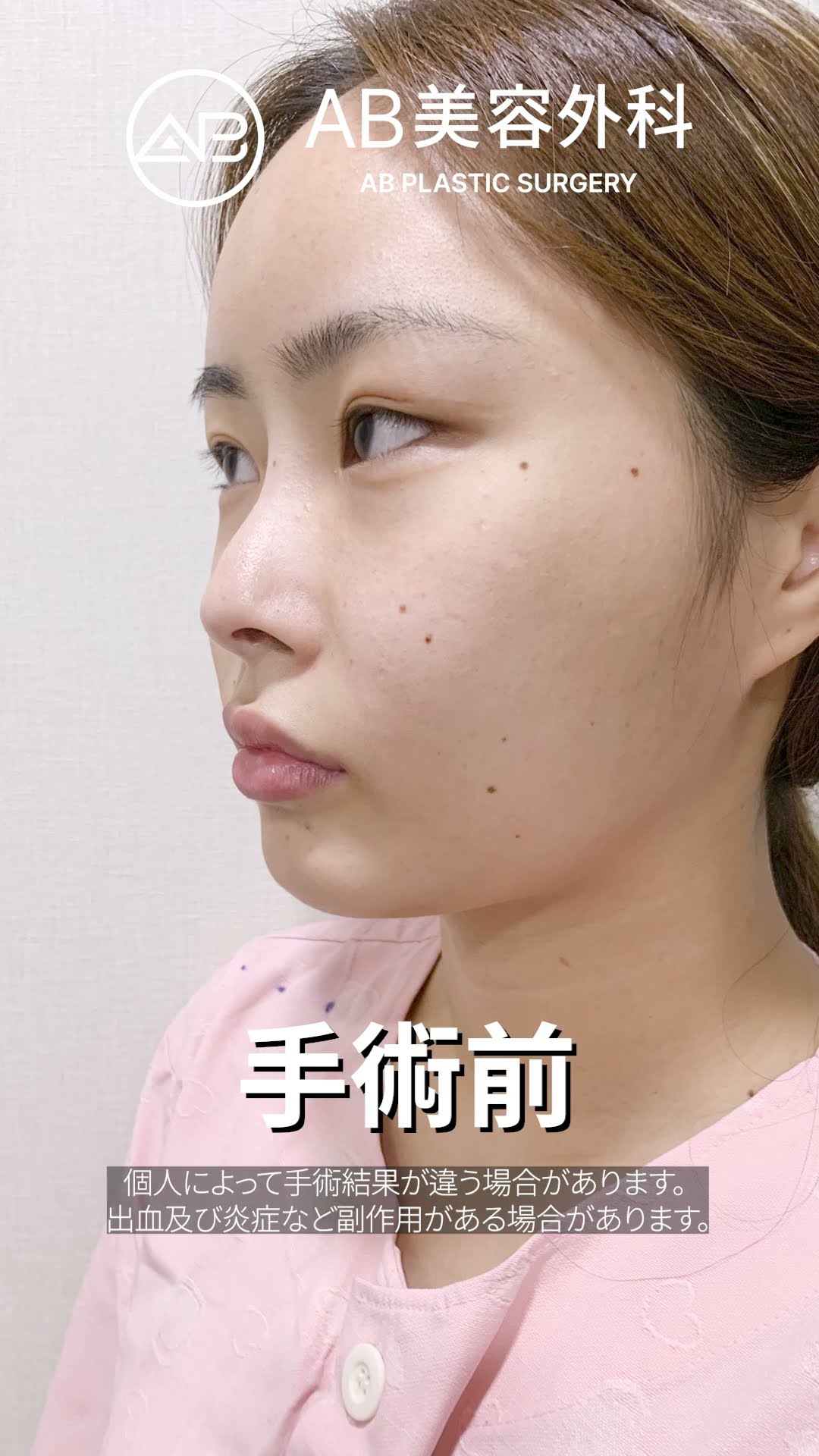 ビフォー・アフター大公開！自然な美しさを叶える整形 #ビフォーアフター