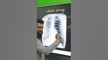 Pneumothorax #xray #ct #mri #radiology #medical #viral #anatomy #pathology #doctor #xrayroom #neet