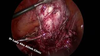 Laparoscopic Myomectomy for a 7 cm Antero lateral Fibroid د لؤي أبوعتيله - استئصال ليف رحمي بالمنظار