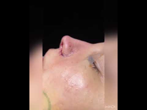 Video thumbnail: 5D Nose Approach - Rhinoplasty - Before & Immediately After · Dr. Anil Shah