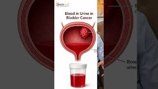 Caught Early, Bladder Cancer Is Beatable #hope #survival #health #drtejindersingh