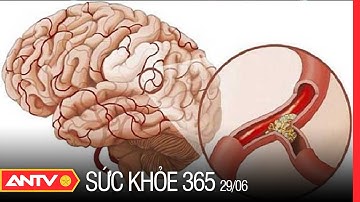 Nhồi Máu Não Và Những Điều Cần Lưu Ý | Sức khỏe 365 | ANTV