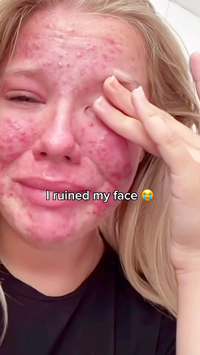 This ONE ingredient fixed my skin when NOTHING else worked ! 🤯 #beeftallow #skincare #acne #fyp