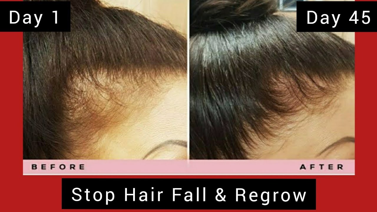 Stop Hair Fall & Regrow Hair Fast Ginger Juice 45 Days Challenge करके