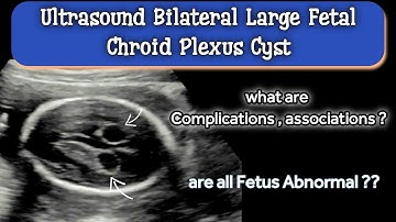 Ultrasound Bilateral Large Fetal Chroid Plexus Cyst |  Associations