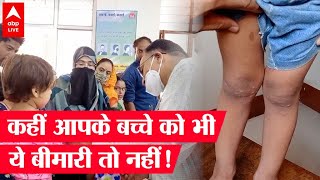 Rajasthan: बच्चों में फैल रहा है coxsackievirus, कहीं आपके बच्चे में भी तो नहीं दिख रहे  ये लक्षण