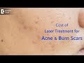 What is the cost of laser treatment for acne & burn scars? - Dr. Rasya Dixit