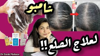 شامبو علاج الصلع ! وأهم الأعراض الجانبيه لشامبو الفطريات و القشرة الأشهر(يسبب الشيب)| فرح محسن Drjoy