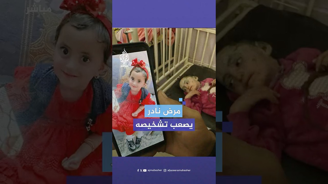 "تبديل ملابسها بمثابة عملية سلخ للجلد".. مرض نادر يهدد حياة الطفلة مريم أبو هلال في غزة